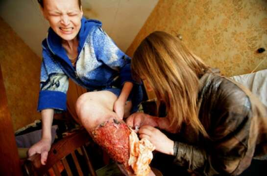 Krokodil la droga que se carcome la piel de los adictos en Rusia